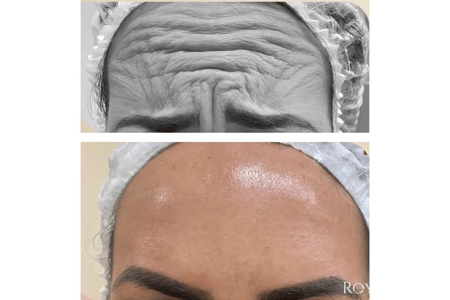 Antes e depois de aplicação de toxina botulínica na testa, com linhas suavizadas